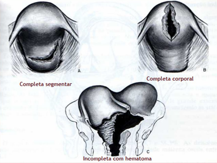 Signos De Rotura Uterina