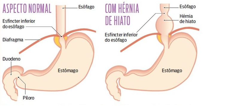 DOENÇA DO REFLUXO GASTROESOFÁGICO (DRGE) - Gastroenterologia